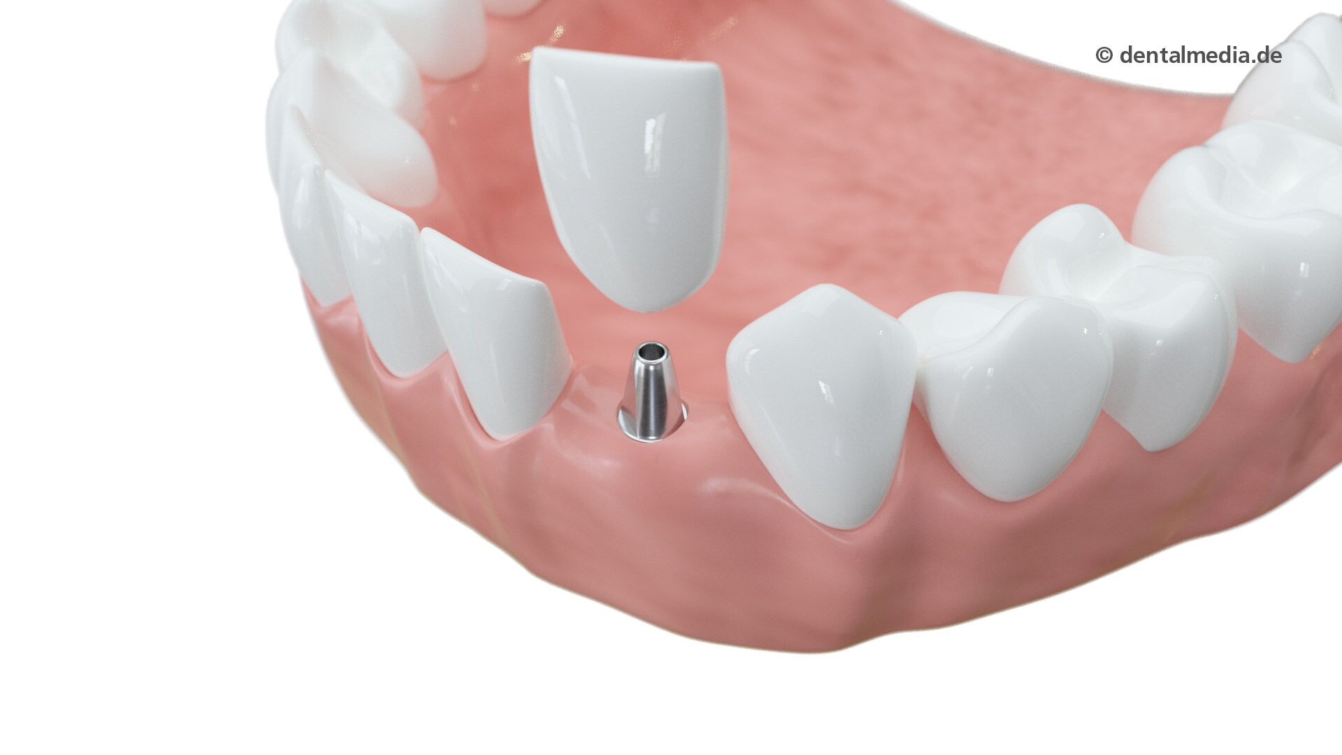 schaltlücke-mit-implantat-und-zahn-5db45af5
